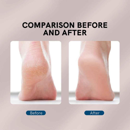 Electric Pedicure Foot File Callus Remover – Smooth & Soft Feet Care Tool